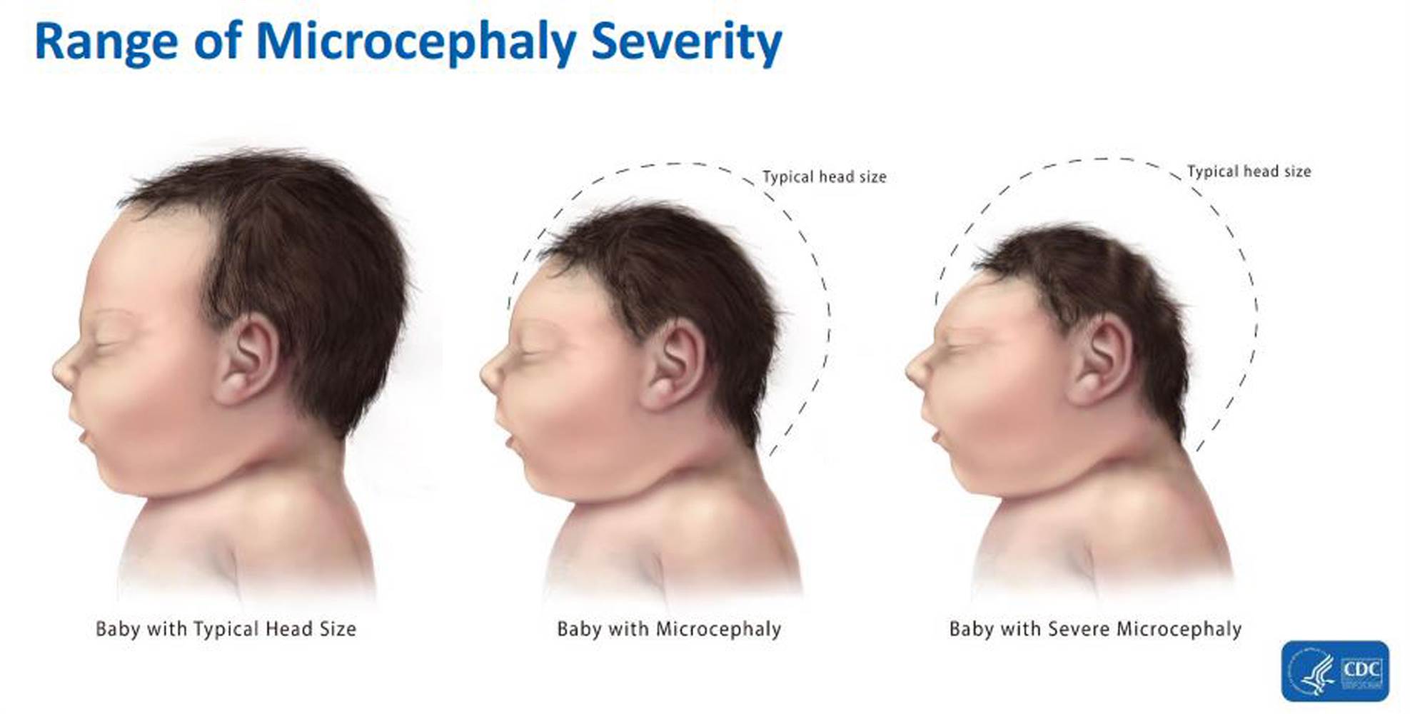 Microcephaly Severity
