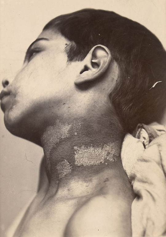 https-::commons.wikimedia.org:wiki:File-Arsenical_pigmentation_of_the_skin_Wellcome_L0062902.jpg