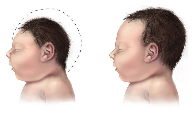 Microcephaly, a condition in which a newborn is born with a larger-than-normal head, is believed to be linked to the Zika virus. Graphic courtesy of Brar_J via Flickr.