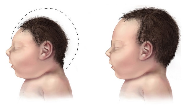 Microcephaly, a condition in which a newborn is born with a larger-than-normal head, is believed to be linked to the Zika virus. Graphic courtesy of Brar_J via Flickr.