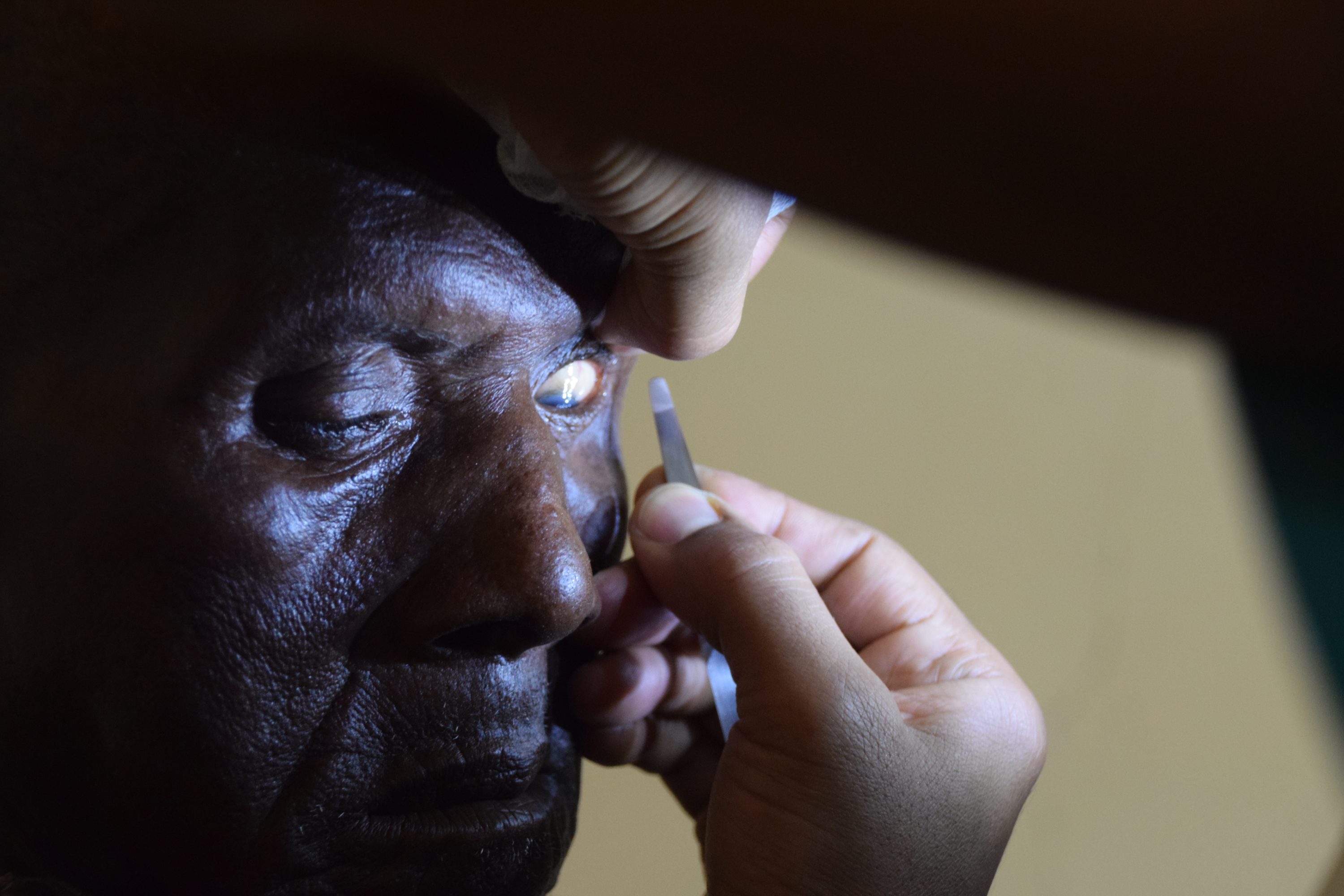 28 Epilation Is Occassionally Used For Postoperative Trichiasis When Only 1 Lash Is Touching And