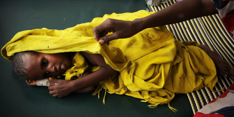 Malnourished child hospitalised Sudan
