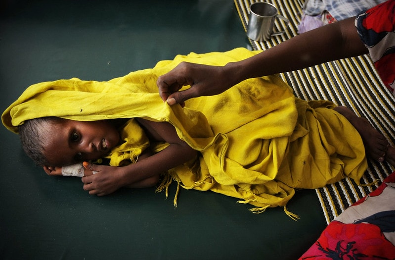 Malnourished child hospitalised Sudan