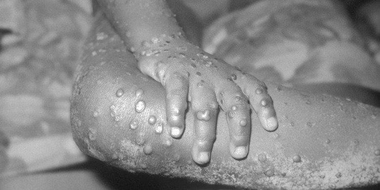 Monkeypox Now Declared a “National Health Emergency” in the US. Should Have This Been Done Sooner?