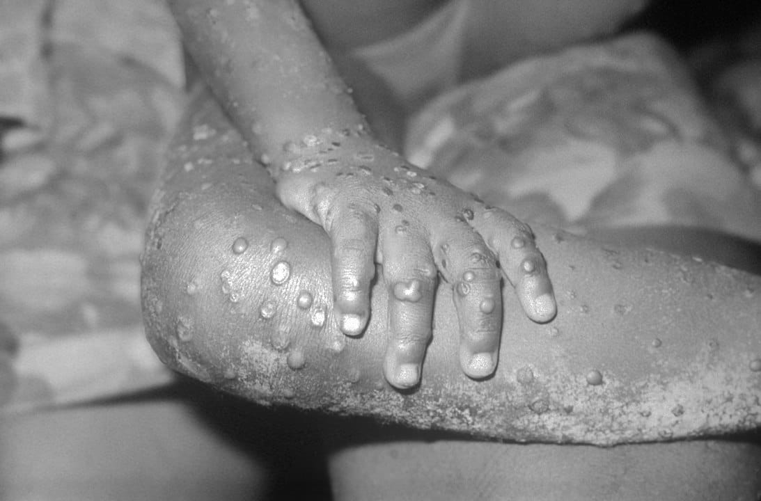 Monkeypox Now Declared a “National Health Emergency” in the US. Should Have This Been Done Sooner?
